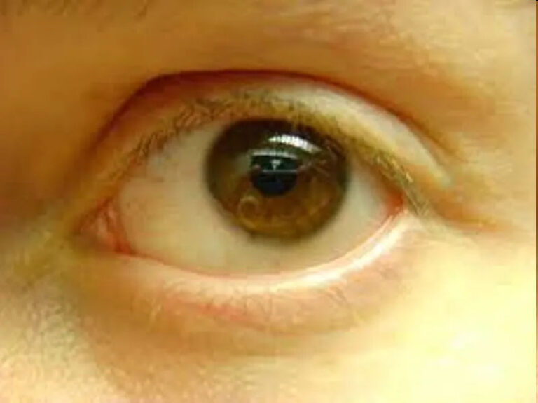 jaundice-outbreak-in-cuttack