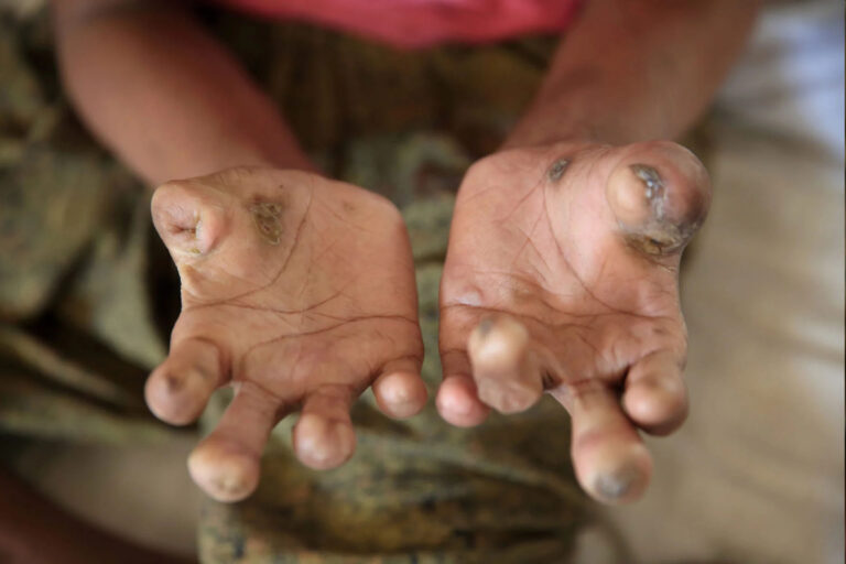 the-stain-of-leprosy-lingers-in-odisha-55000-cases-in-7-years